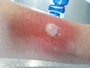 opsite wondspray_