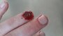 coagulated blood_