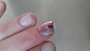 coagulated blood_