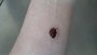 coagulated blood_