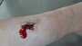 coagulated blood_